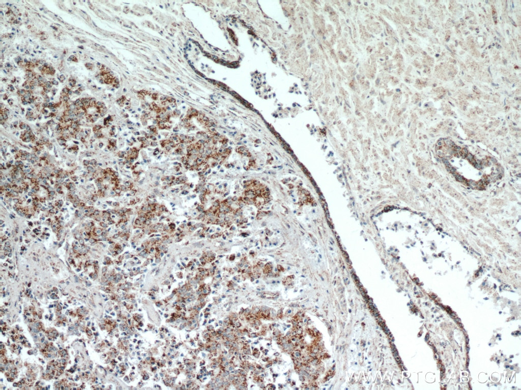 Immunohistochemistry (IHC) staining of human prostate cancer tissue using HIP1-Specific Polyclonal antibody (19688-1-AP)