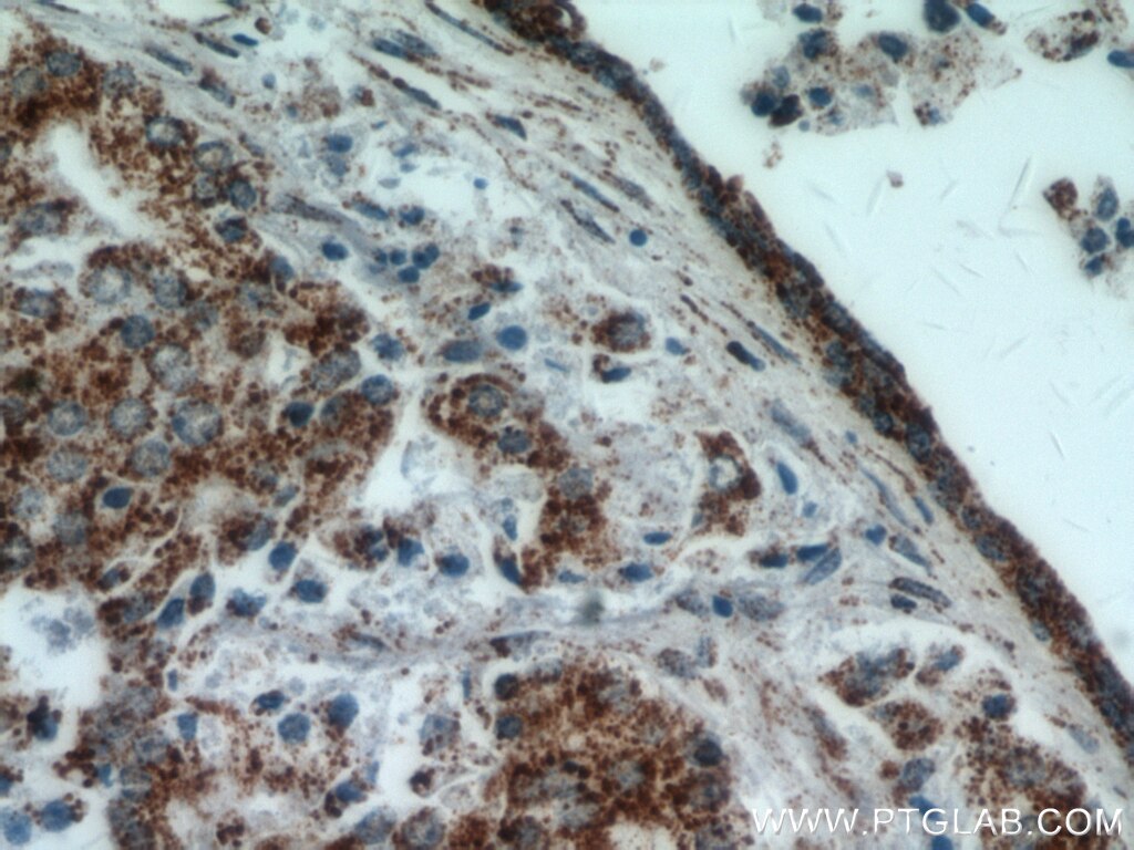 Immunohistochemistry (IHC) staining of human prostate cancer tissue using HIP1-Specific Polyclonal antibody (19688-1-AP)