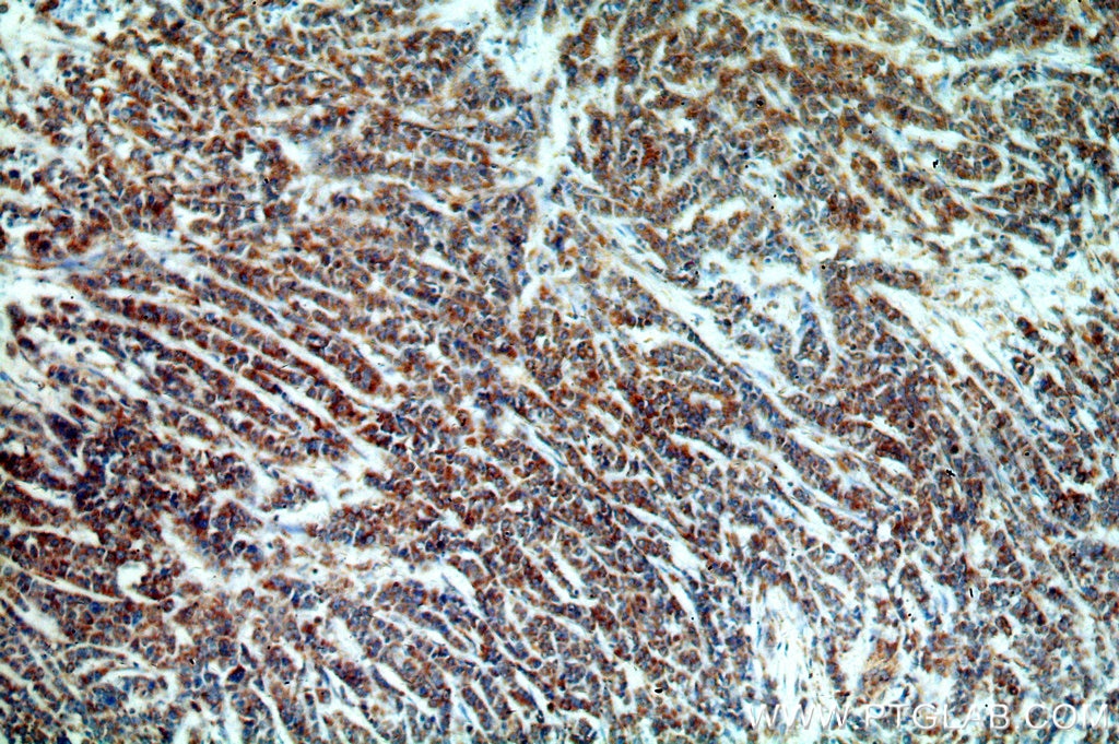Immunohistochemistry (IHC) staining of human colon cancer tissue using HIP1-Specific Polyclonal antibody (19688-1-AP)