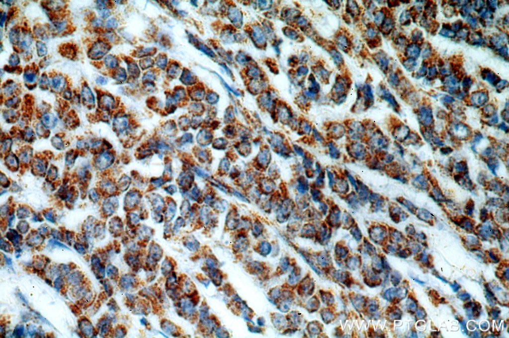 Immunohistochemistry (IHC) staining of human colon cancer tissue using HIP1-Specific Polyclonal antibody (19688-1-AP)