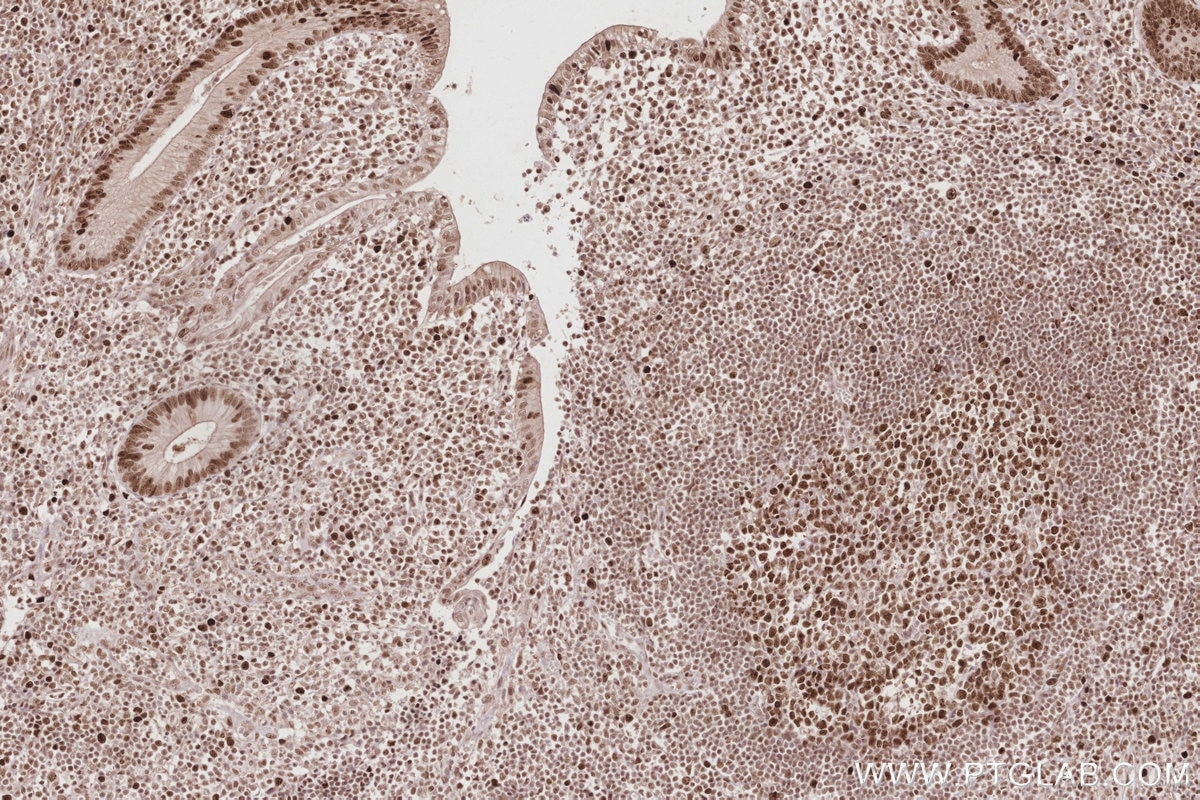 IHC staining of human appendicitis using 14992-1-AP Immunohistochemistry (IHC) staining of human appendicitis tissue using HIRIP3 Polyclonal antibody (14992-1-AP)