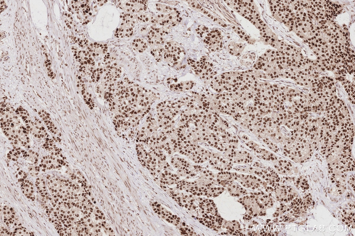 Immunohistochemistry (IHC) staining of human stomach cancer tissue using HIRIP3 Polyclonal antibody (14992-1-AP)