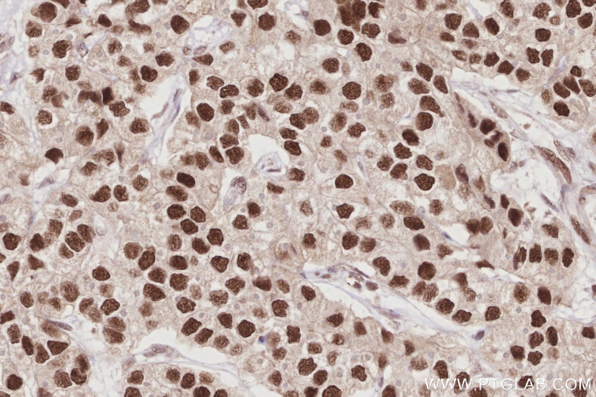Immunohistochemistry (IHC) staining of human stomach cancer tissue using HIRIP3 Polyclonal antibody (14992-1-AP)
