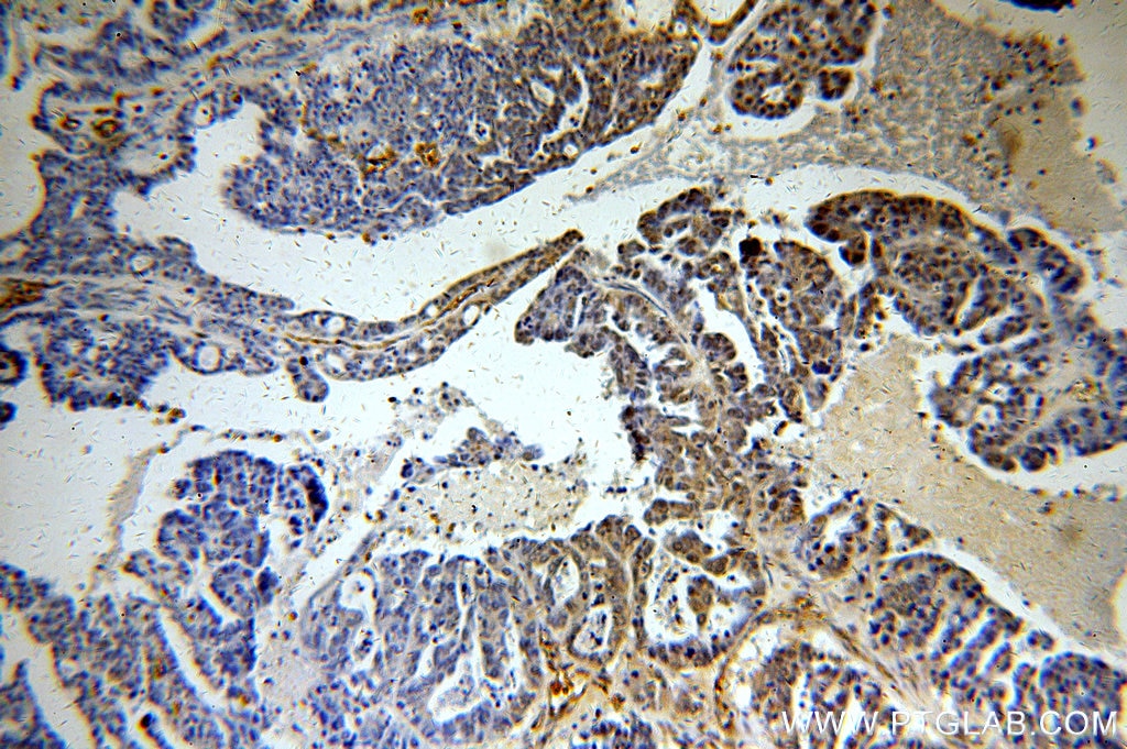 Immunohistochemistry (IHC) staining of human ovary tumor tissue using Histone H1.2 Polyclonal antibody (19649-1-AP)