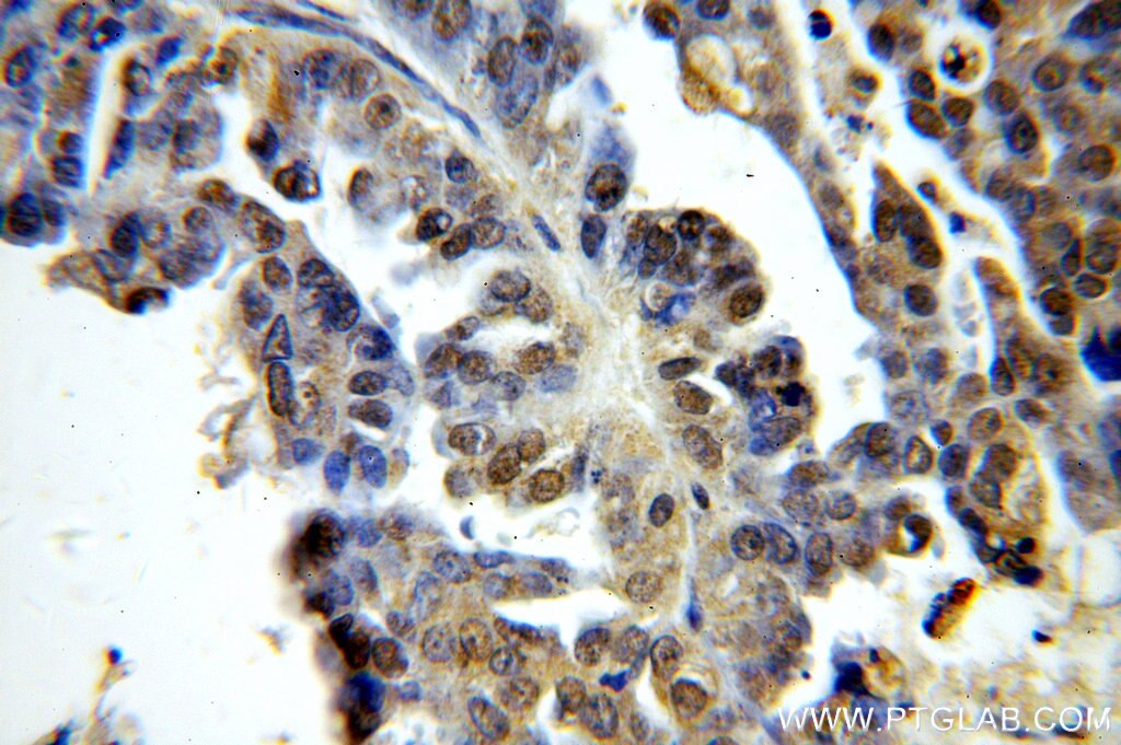 IHC staining of human ovary tumor using 19649-1-AP