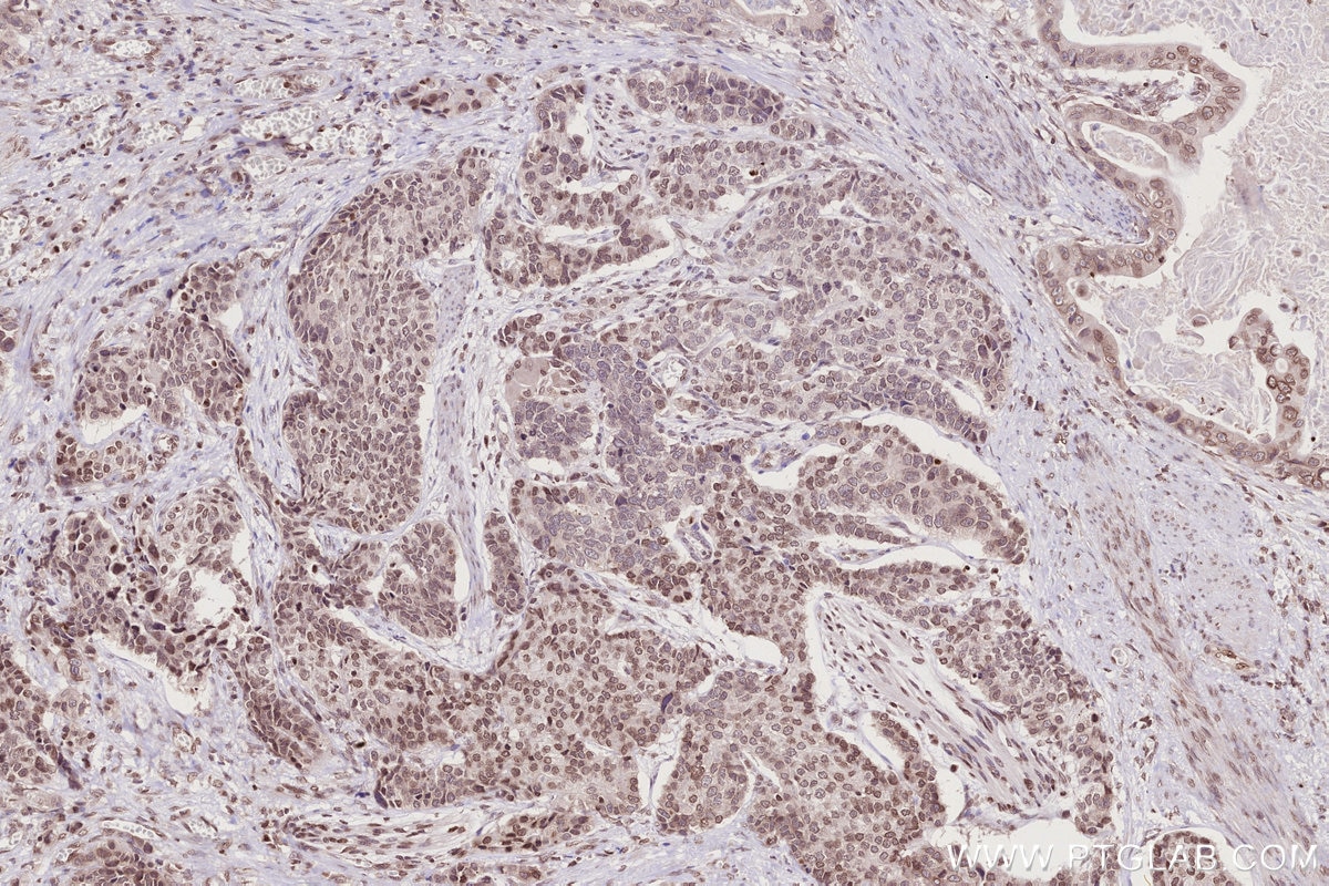 Immunohistochemistry (IHC) staining of human stomach cancer tissue using HIST1H2AC Polyclonal antibody (15953-1-AP)