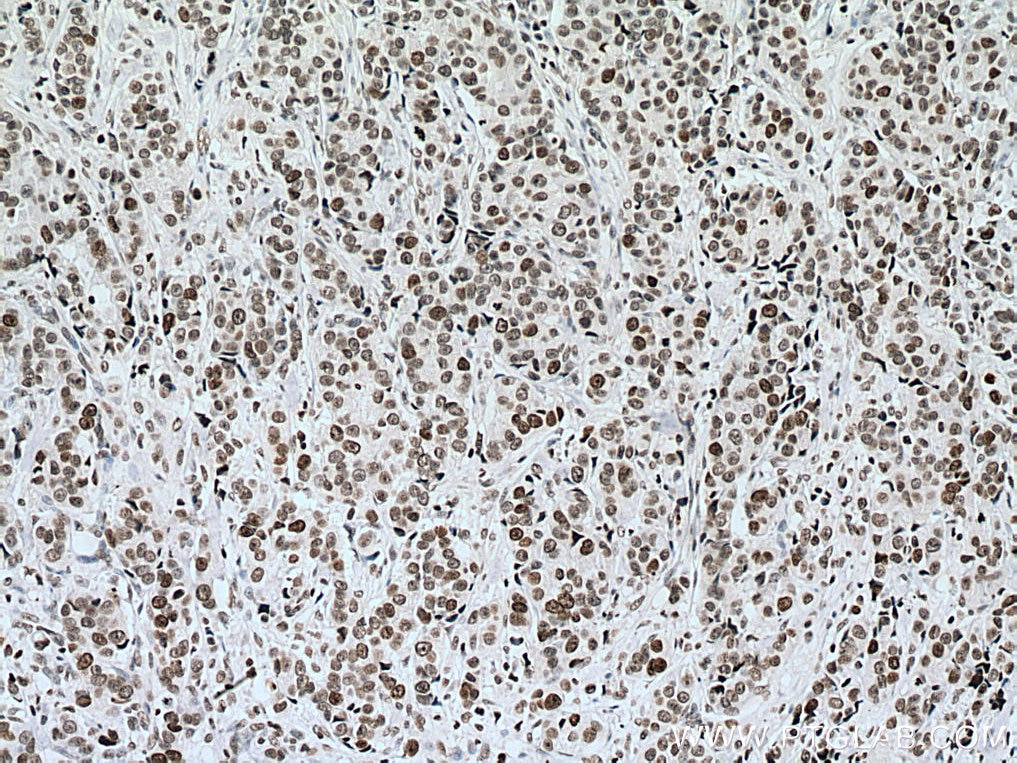 Immunohistochemistry (IHC) staining of human breast cancer tissue using Histone H4 Polyclonal antibody (16047-1-AP)