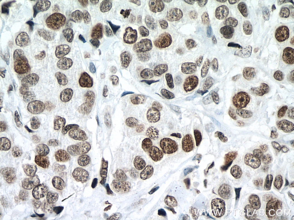 Immunohistochemistry (IHC) staining of human breast cancer tissue using Histone H4 Polyclonal antibody (16047-1-AP)