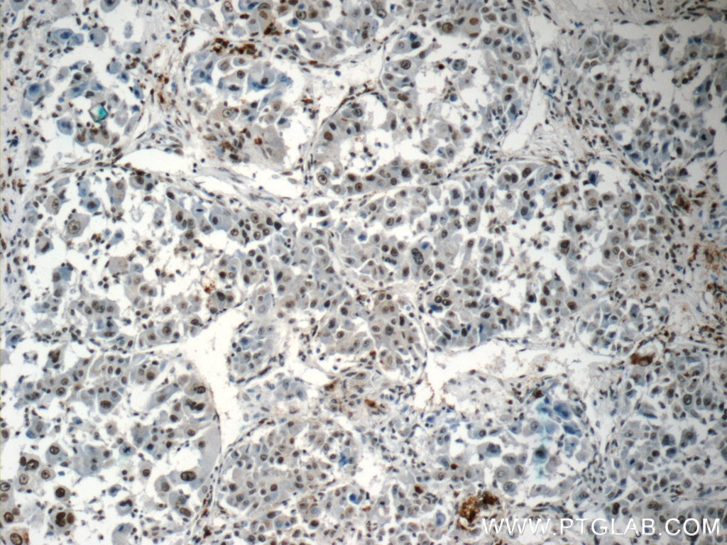 Immunohistochemistry (IHC) staining of human liver cancer tissue using HIST2H2AA4 Polyclonal antibody (15302-1-AP)