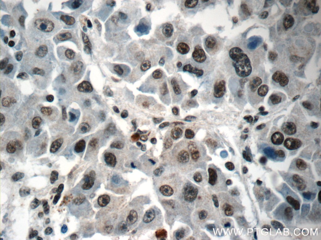 Immunohistochemistry (IHC) staining of human liver cancer tissue using HIST2H2AA4 Polyclonal antibody (15302-1-AP)