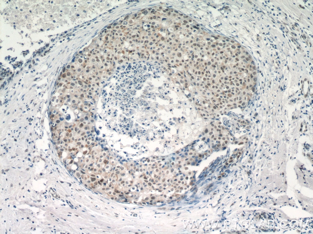 Immunohistochemistry (IHC) staining of human breast cancer tissue using Histone H2B Polyclonal antibody (15857-1-AP)