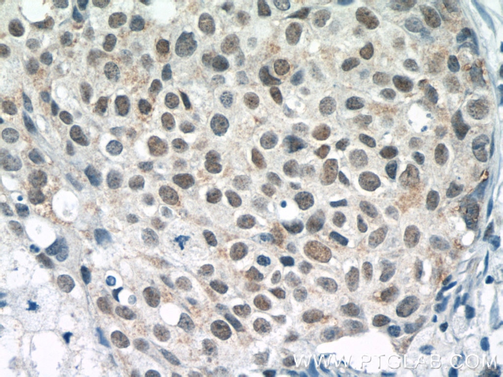Immunohistochemistry (IHC) staining of human breast cancer tissue using Histone H2B Polyclonal antibody (15857-1-AP)