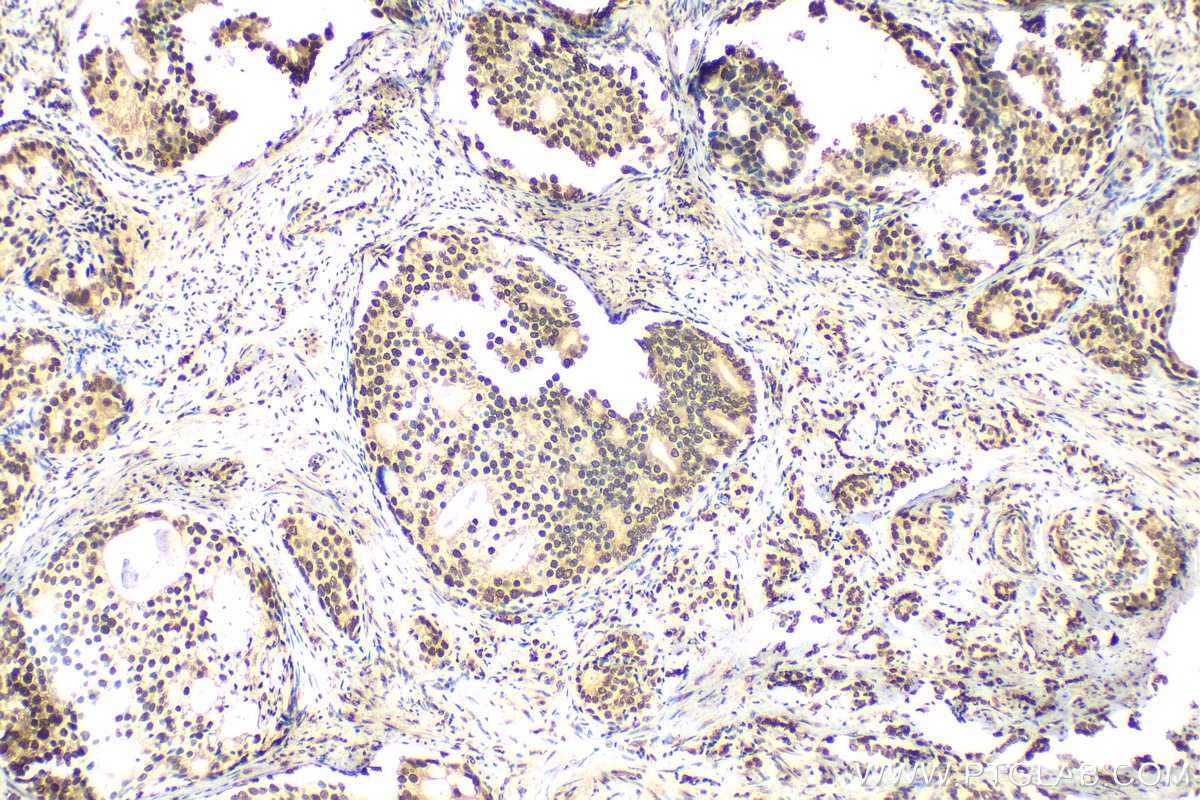 Immunohistochemistry (IHC) staining of human prostate cancer tissue using Histone H2B Polyclonal antibody (15857-1-AP)