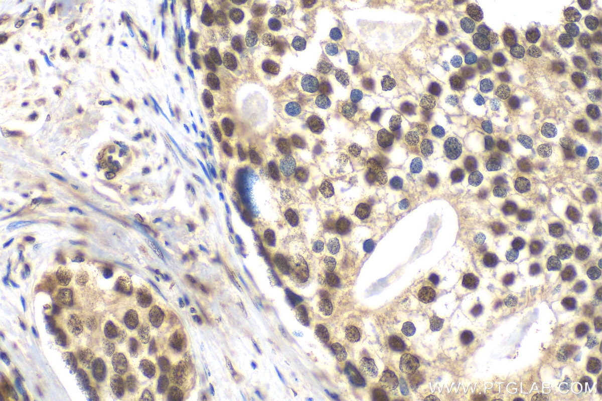 Immunohistochemistry (IHC) staining of human prostate cancer tissue using Histone H2B Polyclonal antibody (15857-1-AP)