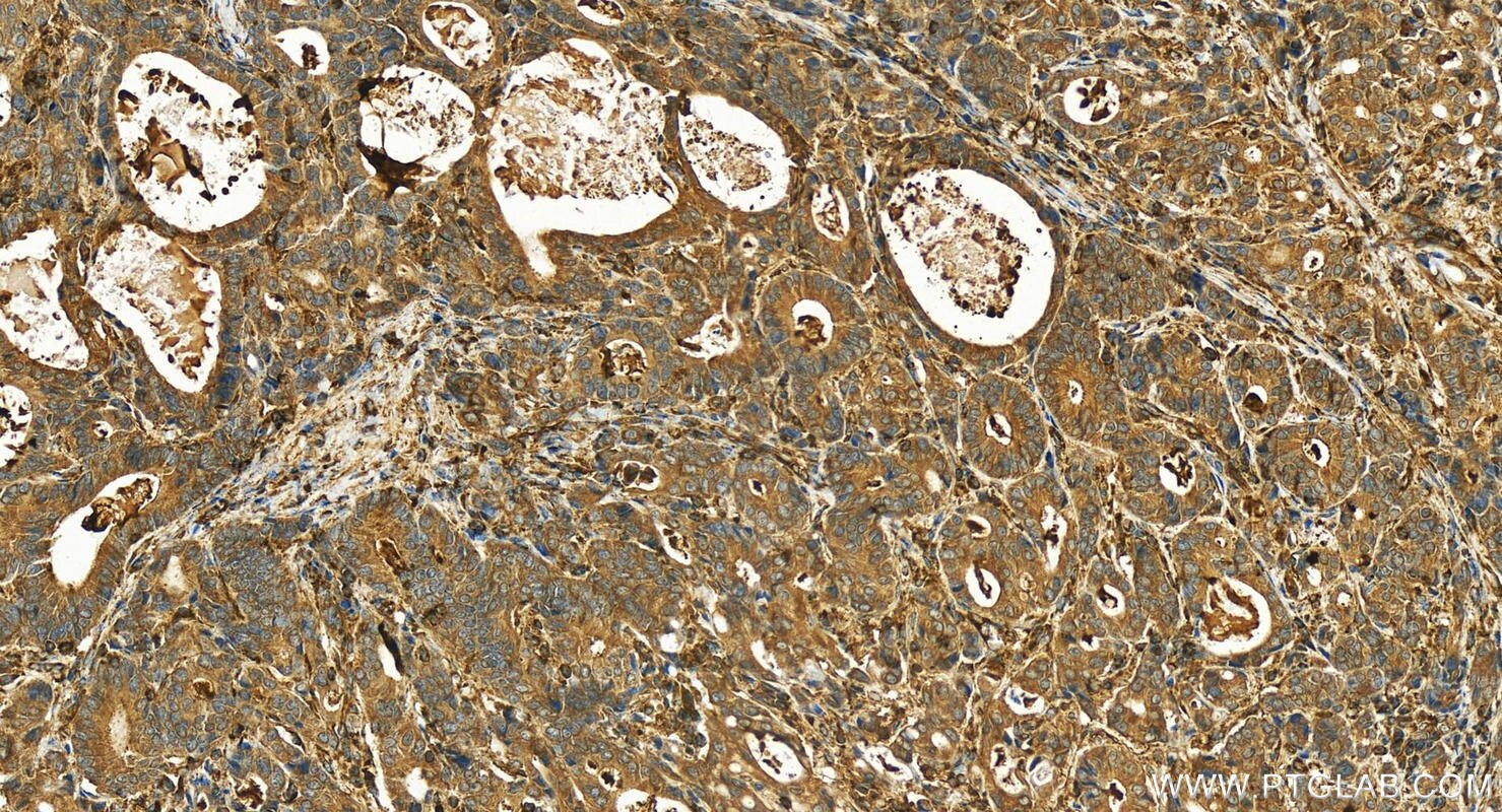 Immunohistochemistry (IHC) staining of human stomach cancer tissue using Hexokinase 1 Polyclonal antibody (19662-1-AP)