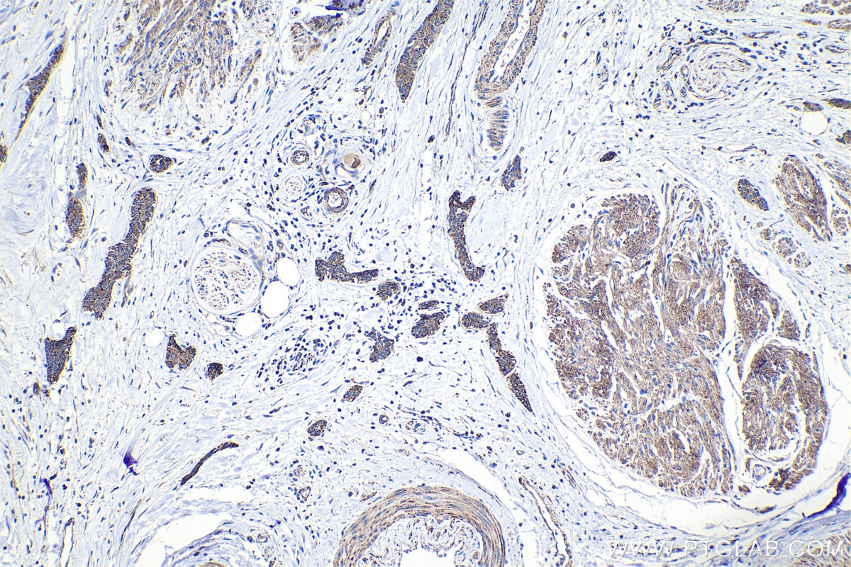 Immunohistochemistry (IHC) staining of human urothelial carcinoma tissue using Hexokinase 2 Polyclonal antibody (22029-1-AP)