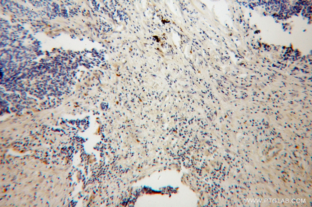 Immunohistochemistry (IHC) staining of human lung cancer tissue using HK3 Polyclonal antibody (13333-1-AP)