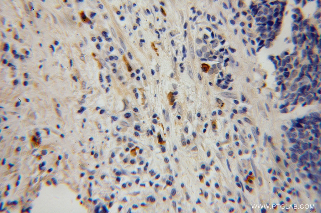Immunohistochemistry (IHC) staining of human lung cancer tissue using HK3 Polyclonal antibody (13333-1-AP)