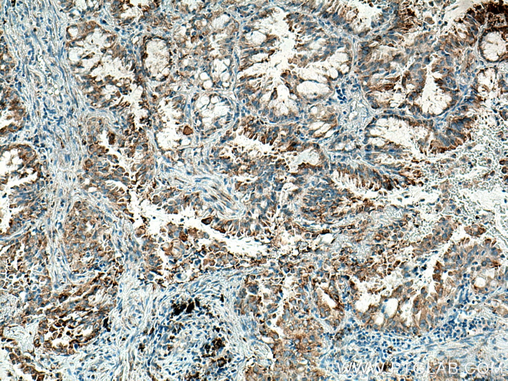 IHC staining of human lung cancer using 67803-1-Ig