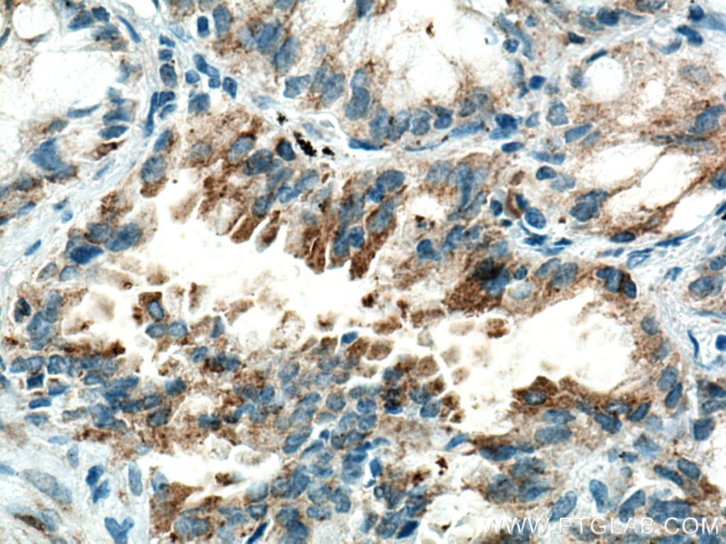 Immunohistochemistry (IHC) staining of human lung cancer tissue using HK3 Monoclonal antibody (67803-1-Ig)