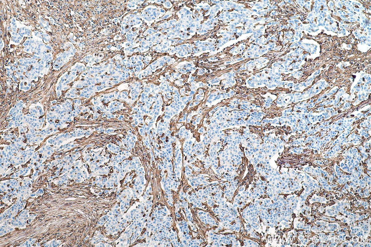 IHC staining of human stomach cancer using 15240-1-AP
