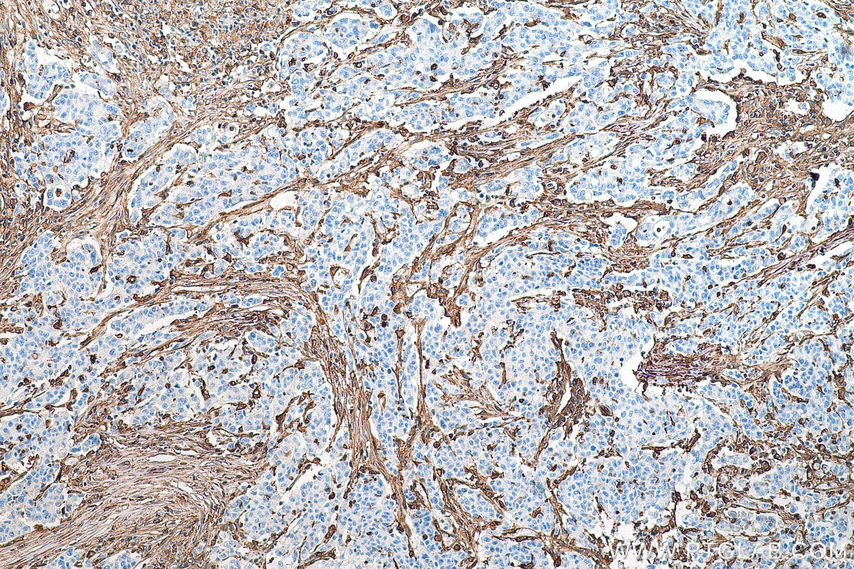 Immunohistochemistry (IHC) staining of human stomach cancer tissue using HLA class I ABC Polyclonal antibody (15240-1-AP)