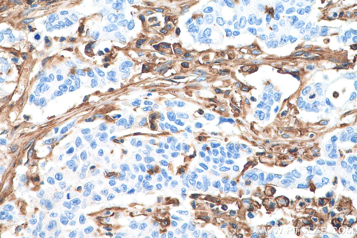 Immunohistochemistry (IHC) staining of human stomach cancer tissue using HLA class I ABC Polyclonal antibody (15240-1-AP)