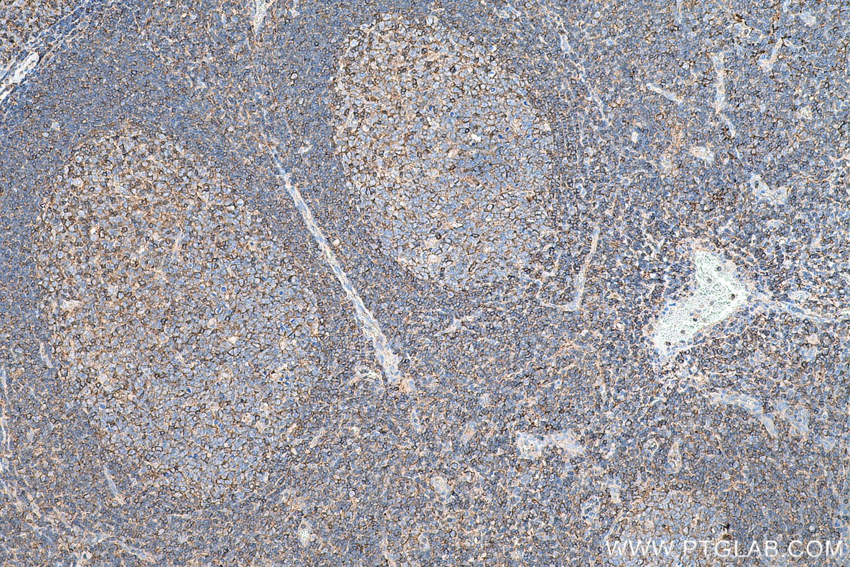 Immunohistochemistry (IHC) staining of human tonsillitis tissue using HLA class I ABC Polyclonal antibody (15240-1-AP)