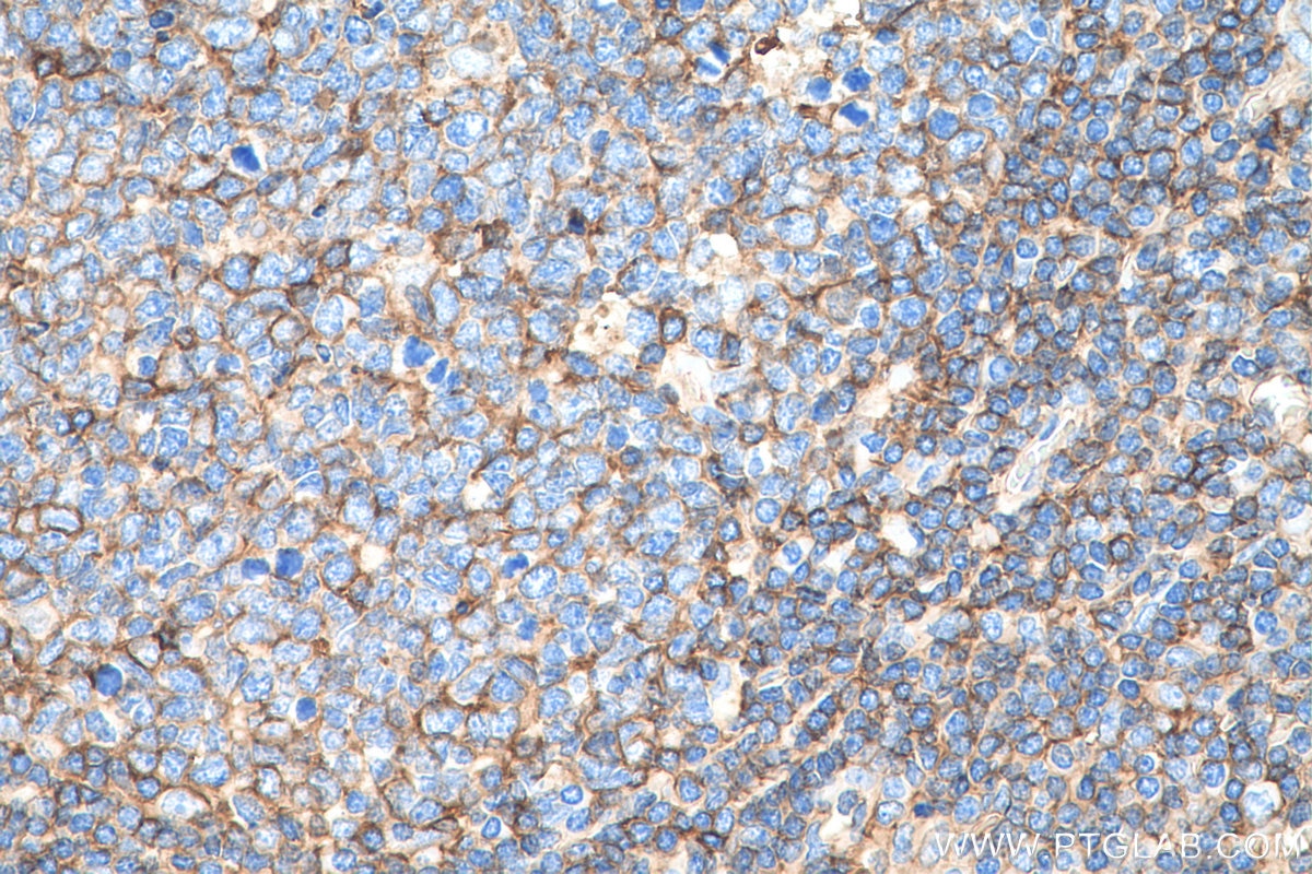 Immunohistochemistry (IHC) staining of human tonsillitis tissue using HLA class I ABC Polyclonal antibody (15240-1-AP)