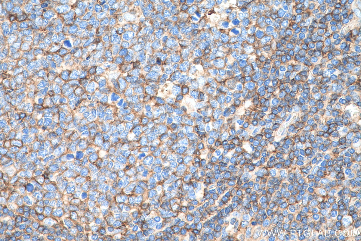 IHC staining of human tonsillitis using 15240-1-AP