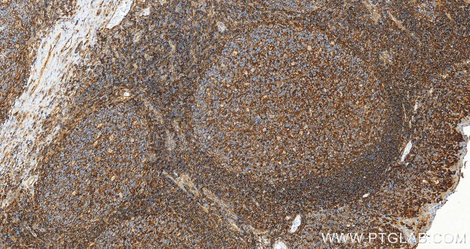 Immunohistochemistry (IHC) staining of human tonsillitis tissue using HLA class I ABC Polyclonal antibody (15240-1-AP)