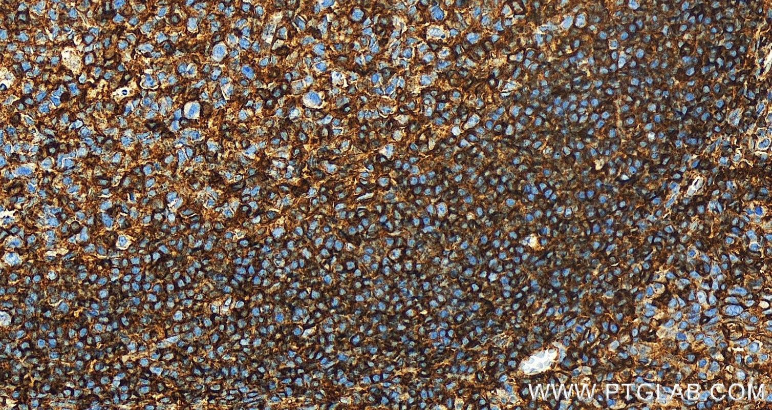 Immunohistochemistry (IHC) staining of human tonsillitis tissue using HLA class I ABC Polyclonal antibody (15240-1-AP)
