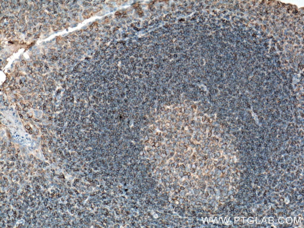 IHC staining of human tonsillitis using 66013-1-Ig