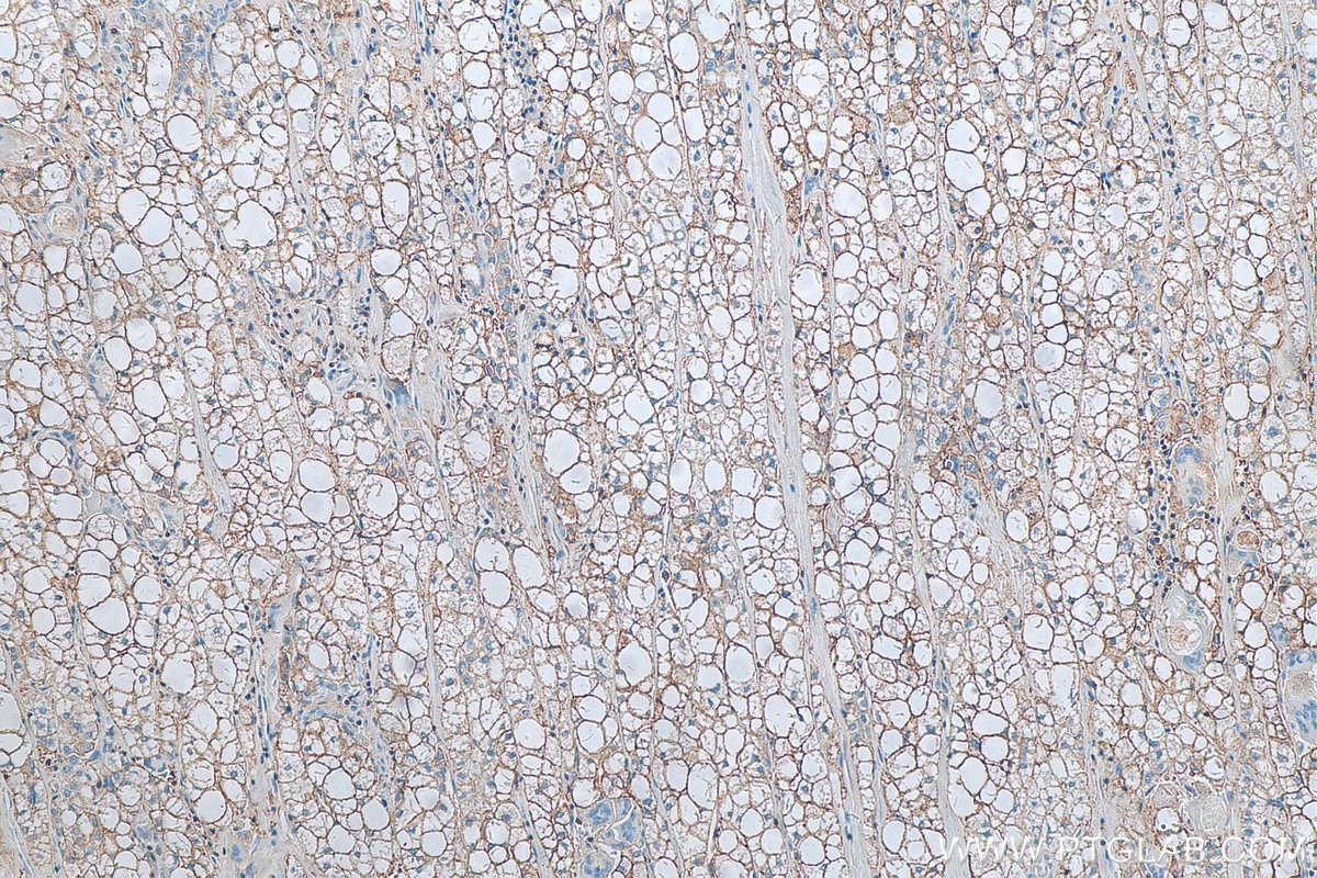 Immunohistochemistry (IHC) staining of human liver cancer tissue using HLA class I ABC Monoclonal antibody (66013-1-Ig)