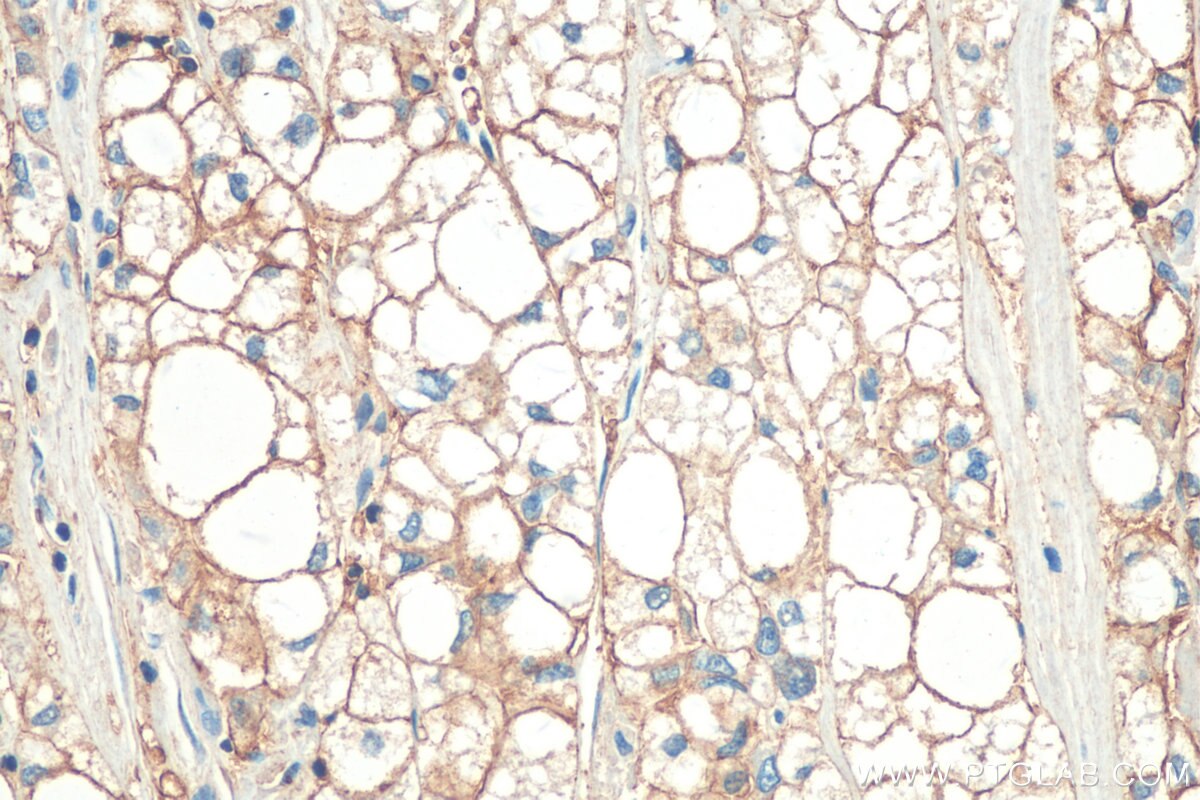 Immunohistochemistry (IHC) staining of human liver cancer tissue using HLA class I ABC Monoclonal antibody (66013-1-Ig)