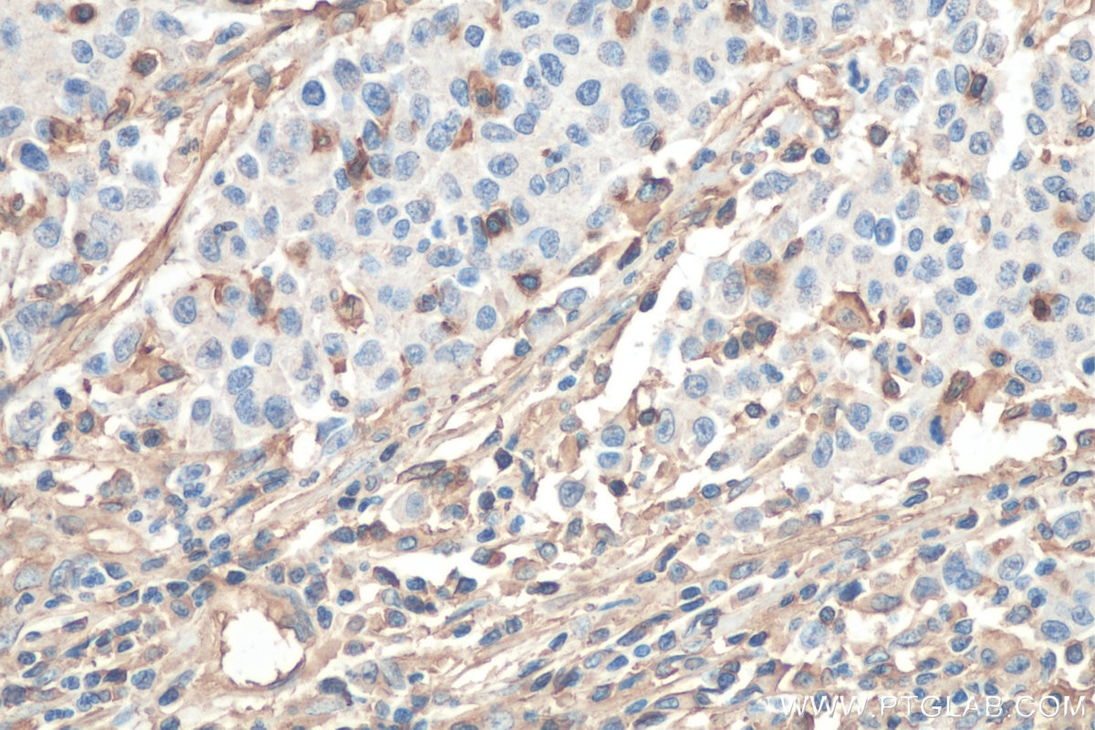 Immunohistochemistry (IHC) staining of human stomach cancer tissue using HLA class I ABC Monoclonal antibody (66013-1-Ig)