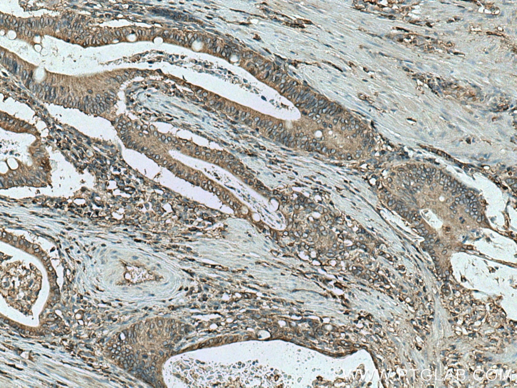 Immunohistochemistry (IHC) staining of human stomach cancer tissue using HLA class I (HLA-B) Polyclonal antibody (17260-1-AP)