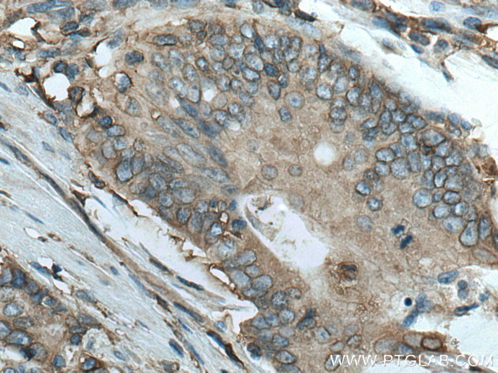 Immunohistochemistry (IHC) staining of human stomach cancer tissue using HLA class I (HLA-B) Polyclonal antibody (17260-1-AP)