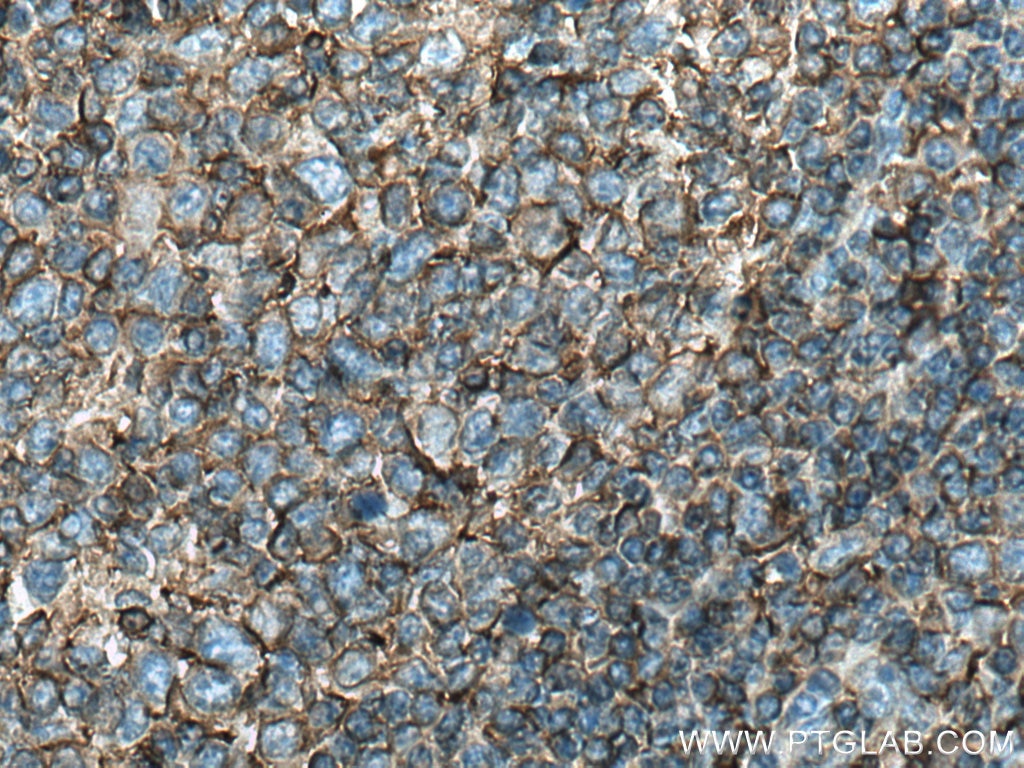 Immunohistochemistry (IHC) staining of human tonsillitis tissue using HLA class I (HLA-B) Polyclonal antibody (17260-1-AP)