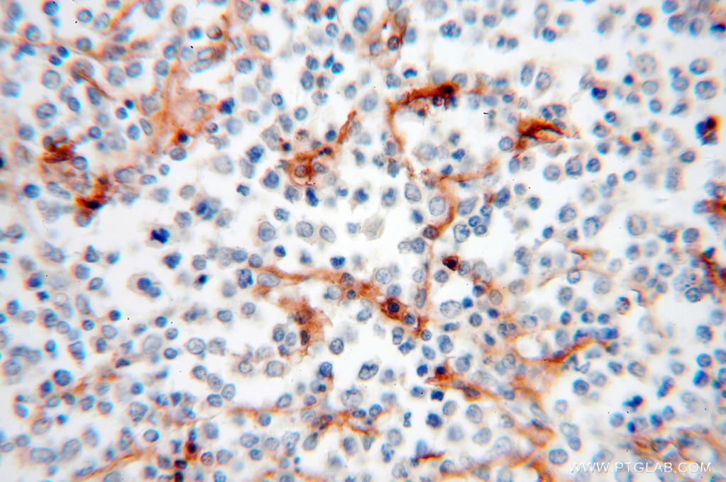 Immunohistochemistry (IHC) staining of human lymphoma tissue using HLA class I (HLA-C) Polyclonal antibody (15777-1-AP)