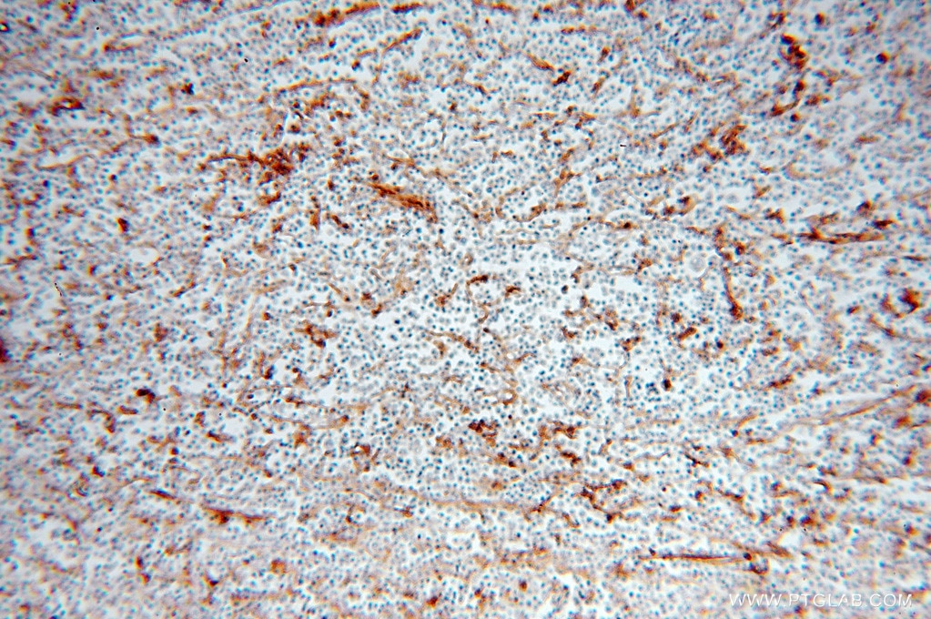 Immunohistochemistry (IHC) staining of human lymphoma tissue using HLA class I (HLA-C) Polyclonal antibody (15777-1-AP)