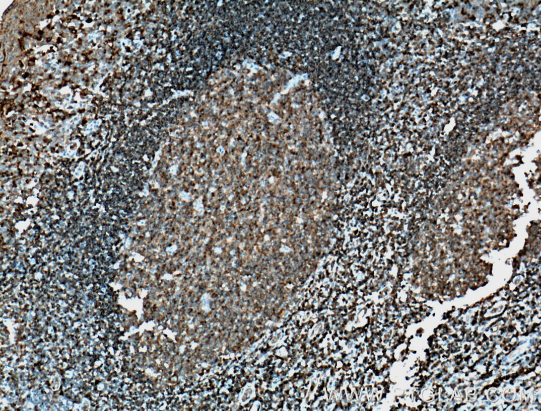 Immunohistochemistry (IHC) staining of human tonsillitis tissue using HLA-DMB Polyclonal antibody (21704-1-AP)