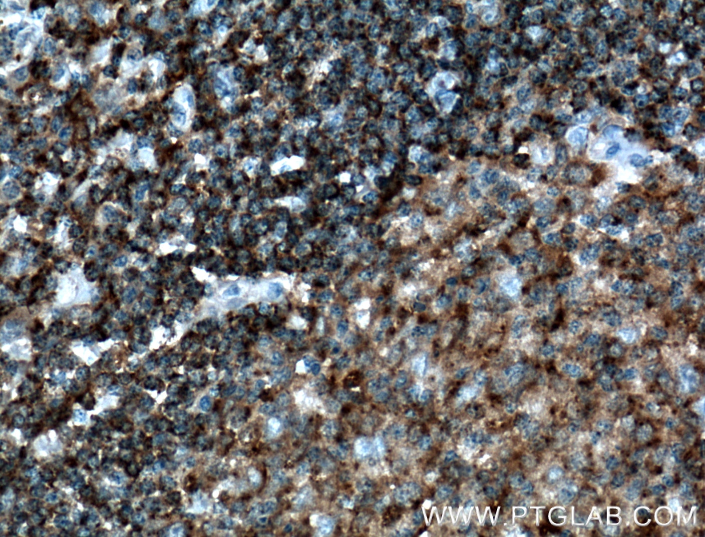 Immunohistochemistry (IHC) staining of human tonsillitis tissue using HLA-DMB Polyclonal antibody (21704-1-AP)