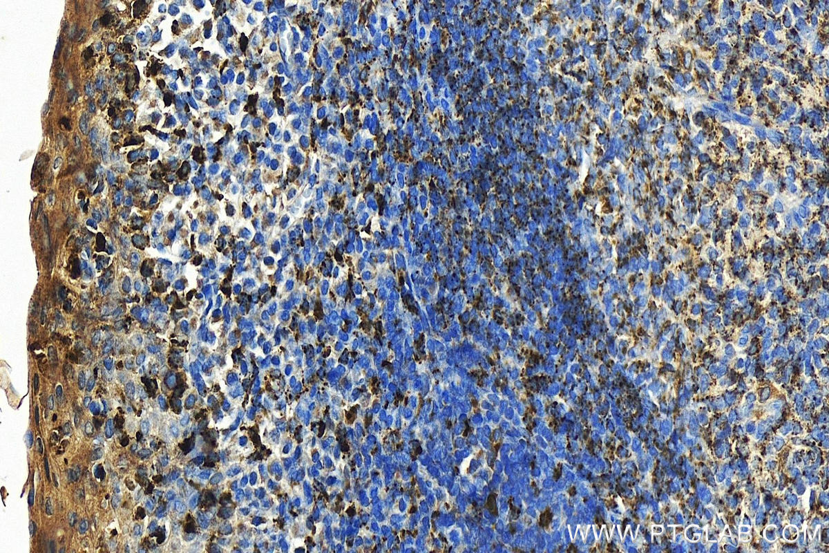 Immunohistochemistry (IHC) staining of human tonsillitis tissue using HLA-DMB Polyclonal antibody (21704-1-AP)