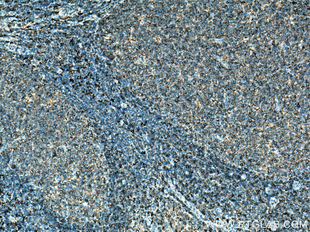 Immunohistochemistry (IHC) staining of human tonsillitis tissue using HLA-DPA1 Polyclonal antibody (16109-1-AP)