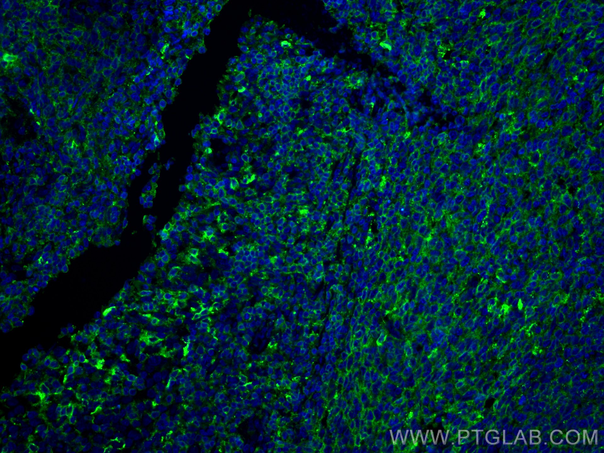 IF Staining of human tonsillitis using 11298-1-AP