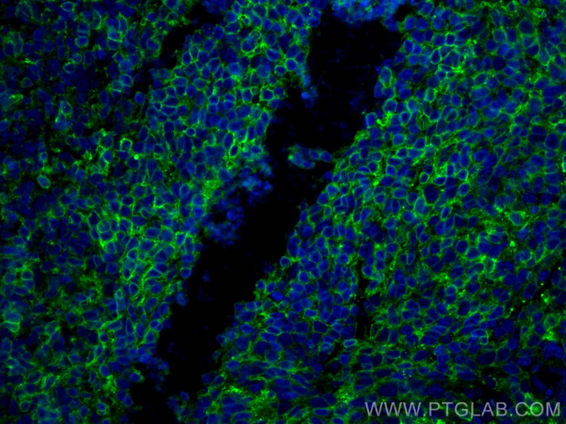 IF Staining of human tonsillitis using 11298-1-AP