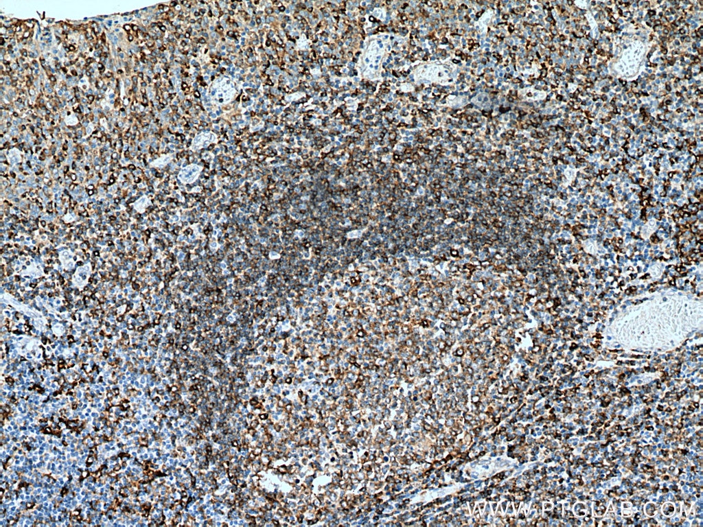 IHC staining of human tonsillitis using 11298-1-AP