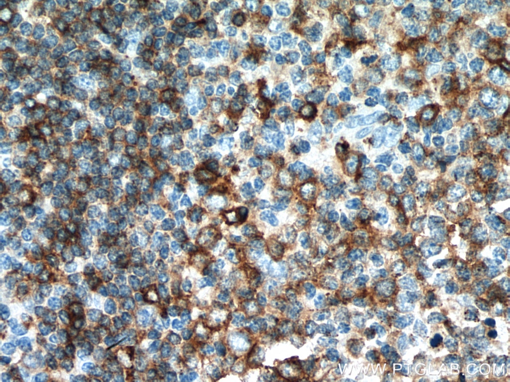 Immunohistochemistry (IHC) staining of human tonsillitis tissue using HLA-DPB1 Polyclonal antibody (11298-1-AP)