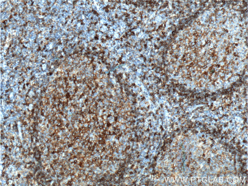 Immunohistochemistry (IHC) staining of human tonsillitis tissue using HLA-DQA1 Polyclonal antibody (16918-1-AP)